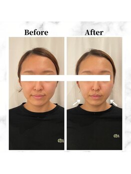 ザビューティー 麻布十番本店(The Beauty)/12Dリフト全顔打ち放題[リフト]