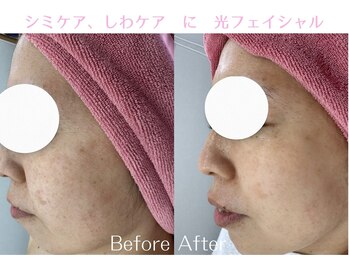 Cスキンケアクリニック 麻布店/光フェイシャルBeforeAfter