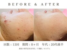 ロエヴェ(ROEWE)/ニキビ改善・毛穴ケア・肌質改善