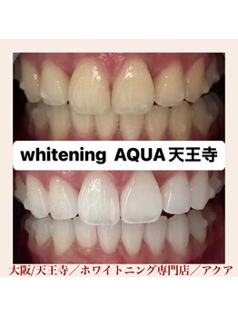 アクア 天王寺店(AQUA)/セルフホワイトニング/天王寺