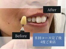 ホワイトニングカフェ 原宿店/◎歯のホワイトニング施術写真◎