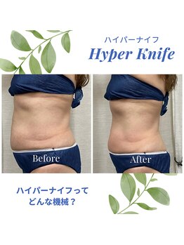 ハリルル 併設 GLケンタ鍼灸整骨院(HARILULU)/上半身ダイエット