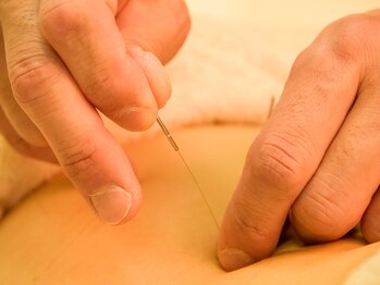 マハロ港南スポーツはりきゅう接骨院/鍼でツボに刺激を加えます。