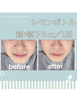 ハロ 南青山(HALO)/小顔レモンボトル3cc