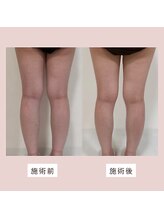 ミーティス/浮腫まない足を目指して