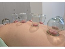 ムラサキ鍼灸治療院(MURASAKI鍼灸治療院)の雰囲気（むくみや血行促進、自律神経の調整にカッピングも出来ます。）