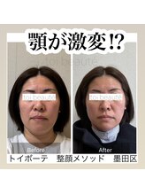 トイボーテ(toi beaute)/小顔矯正で顎縮小！？