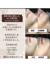 リムル(REMURU)/20代後半のお客様　髭脱毛2回目