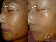 パールホワイトニングサロン 大和店/ハーブピーリングでトラブル改善