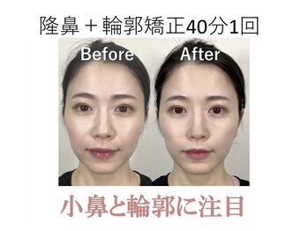 ラプリ 梅田店(Raplit)/隆鼻＋輪郭矯正40分1回