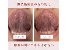 鍼灸院ハリーユ(HARIeyu)/【全身鍼灸施術後のお血の変化】