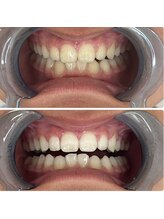 グリッター ショウナン(glitter. SHONAN)/歯のホワイトニングbefore/after