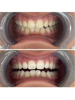 グリッター ショウナン(glitter. SHONAN)/歯のホワイトニングbefore/after