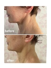 ウィッシュプロサロンケー(WISHpro salon K)/首のしわ
