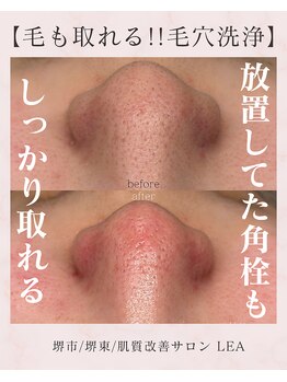 レア(Lea)/硬くなった角栓も綺麗に＊
