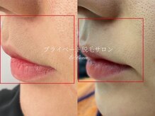 エクボ(EcBeau)/お顔脱毛モニターさまお写真