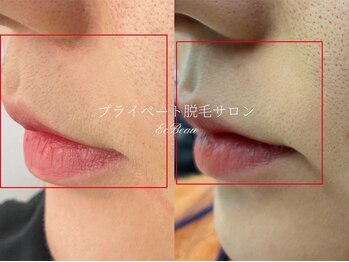 エクボ(EcBeau)/お顔脱毛モニターさまお写真