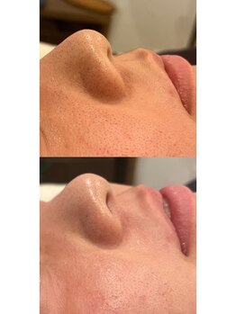 ハルユイ(haruyui)/毛穴洗浄