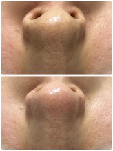 プルティティア(Pultitia)/毛穴洗浄