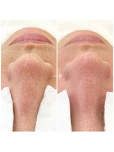 レディ(Lady)/毛穴洗浄