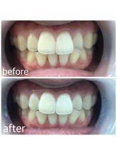 ホワイトニングカフェ 岸和田店(WhiteningCafe)/16分×2回照射