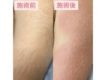 オーキ 横浜(Orchi)/硬毛化部位の脱毛