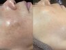 《シミしわ卒業ケア》肌解析+オ-ダ-メイド施術+乳酸ピ-リング+美容液導入