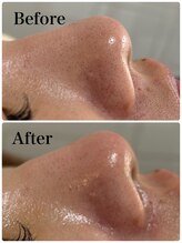 モテ 新宿店(Mote)/ハイドラ毛穴洗浄＋艶肌Wax 新宿