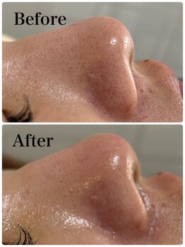 モテ 新宿店(Mote)/ハイドラ毛穴洗浄＋艶肌Wax 新宿