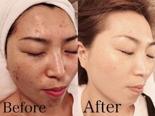 都/結果重視のハーブピーリング