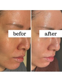 アルバ 広島店(ALBA)/【エイジングケア】水光毛穴除去