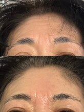 ルミア(LUMiA)/おでこの横ジワ・眉間のシワ改善