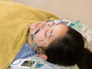 いなほ はりきゅう整骨院 東新宿/美容鍼施術/手順2