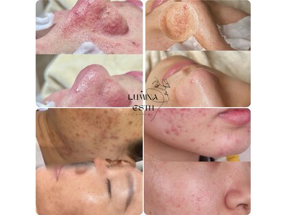 ルミナエステ(LUMINA ESTH)の写真