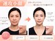 シャイニングビューティー 表参道(Shining Beauty)の写真/顔輪郭スッキリへ！切らないリフトでほうれい線改善を目指すケア、術後ケアも対応★
