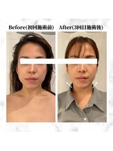 ザビューティー 麻布十番本店(The Beauty)/12Dリフト全顔打ち放題[リフト]