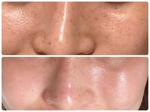 ジェミニ フェイス デザイン(Gemini Face Design)/REVI陶肌トリートメント