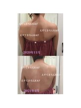 えすてさろん ケイアンドエフ(k&f)/【背中ケア】施術結果5ヶ月/９回