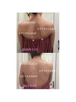 えすてさろん ケイアンドエフ(k&f)/【背中ケア】施術結果5ヶ月/９回