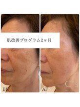 シーズ(C’s)/ＡＤＳ化粧品使用2か月