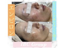 IBC 上大岡店/エンビロンフェイシャル