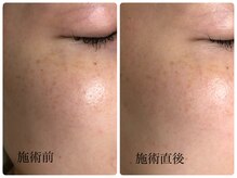 シェミー(CHEZ MEE)/シミに働きかけアプローチ*乾燥