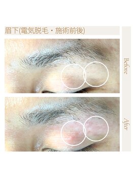 エスト(Est_.)/美容電気脱毛【眉下】