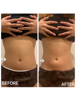 トータルケア・マッサージ 都立大学/痩身マシン・参考写真(1)