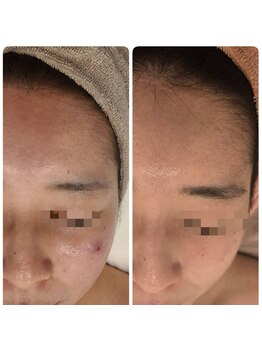 サロン ド ハニー(Salon de Honey)/陶肌ハーブピーリング×プラズマ