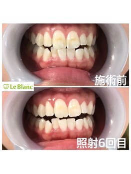 ルブラン 奈良店(Le Blanc)/照射6回目!回数券通い!