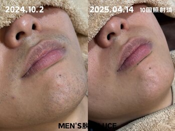 ルーチェ/【ヒゲ脱毛】継続がカギ!