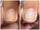 巻き爪ケア（UPジェル）