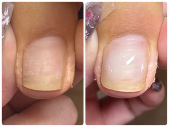 巻き爪ケア(UPジェル)