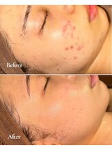 アラモア(ARAMOA)/剥離なし沖縄産ハーブピーリング